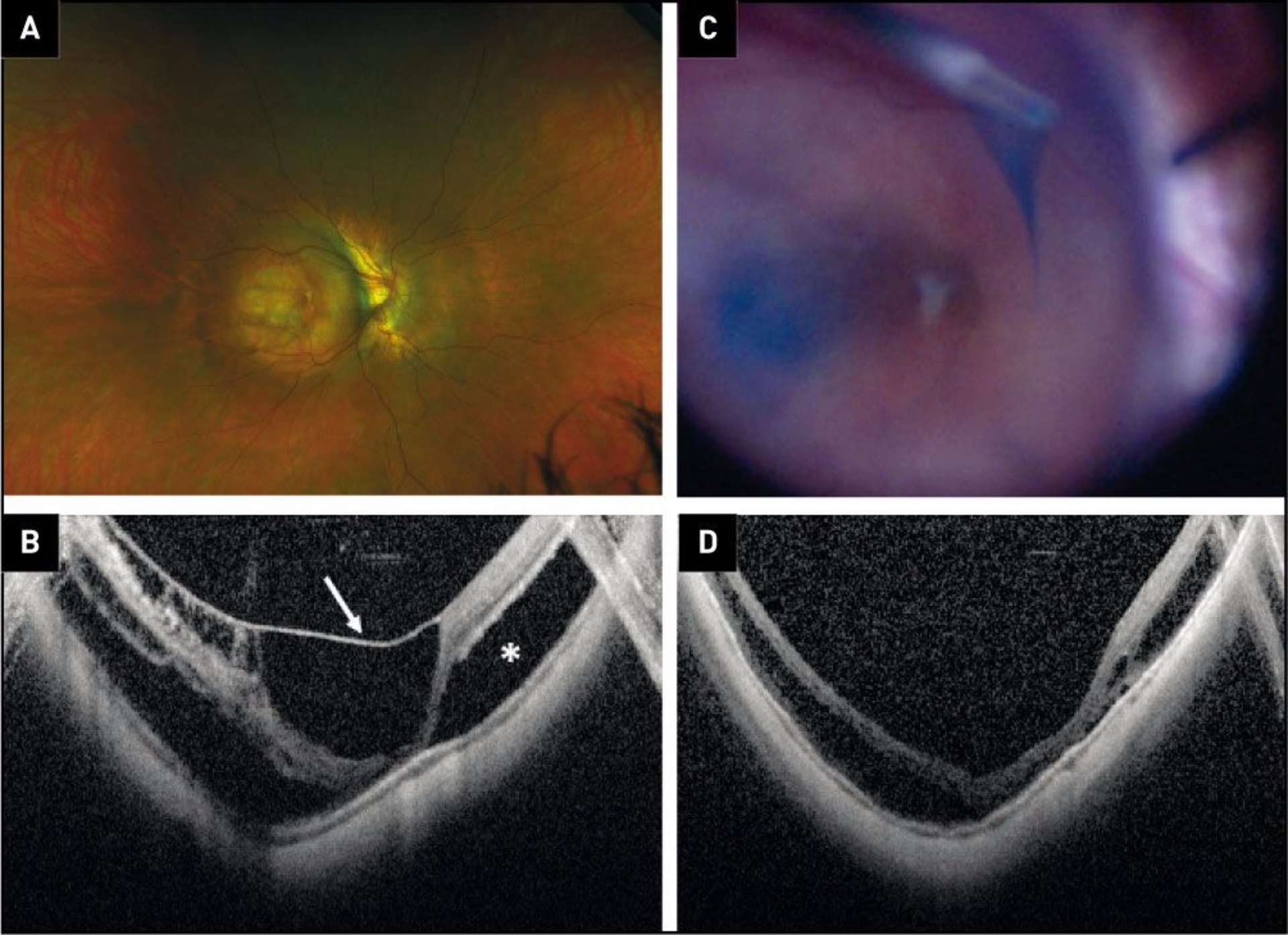 Figure 3. Exemple de chirurgie du FS. A. On note un staphylome postérieur extrêmement profond chez cette patiente. B. Le FS est associé à un décollement de la limitante interne (flèche) et à un DSR (astérisque). C. La limitante est largement disséquée. D. Les résultats anatomiques et visuels sont satisfaisants (VLMB en préopératoire et 3/10 en postopératoire).
