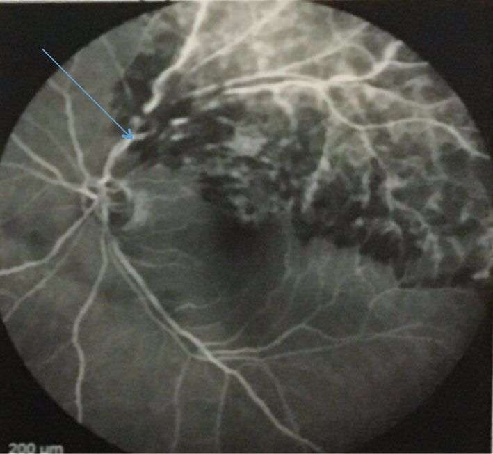Figure 2. OBVR chez une patiente de 60 ans dont le bilan révèle une hypercholestérolémie (LDL élevé), une hypertriglycéridémie et un acide urique limite. L’angiographie rétinienne révèle, aux temps tardifs, une occlusion de VTS au site du croisement artérioveineux (flèche bleue) avec dilatation des branches veineuses en amont.&nbsp;
