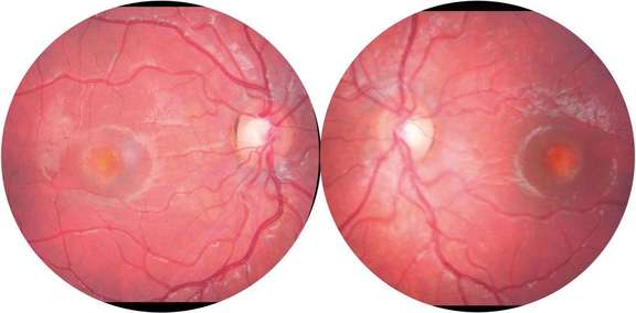 La maladie de Best en pratique aujourd’hui - cahiers-ophtalmologie