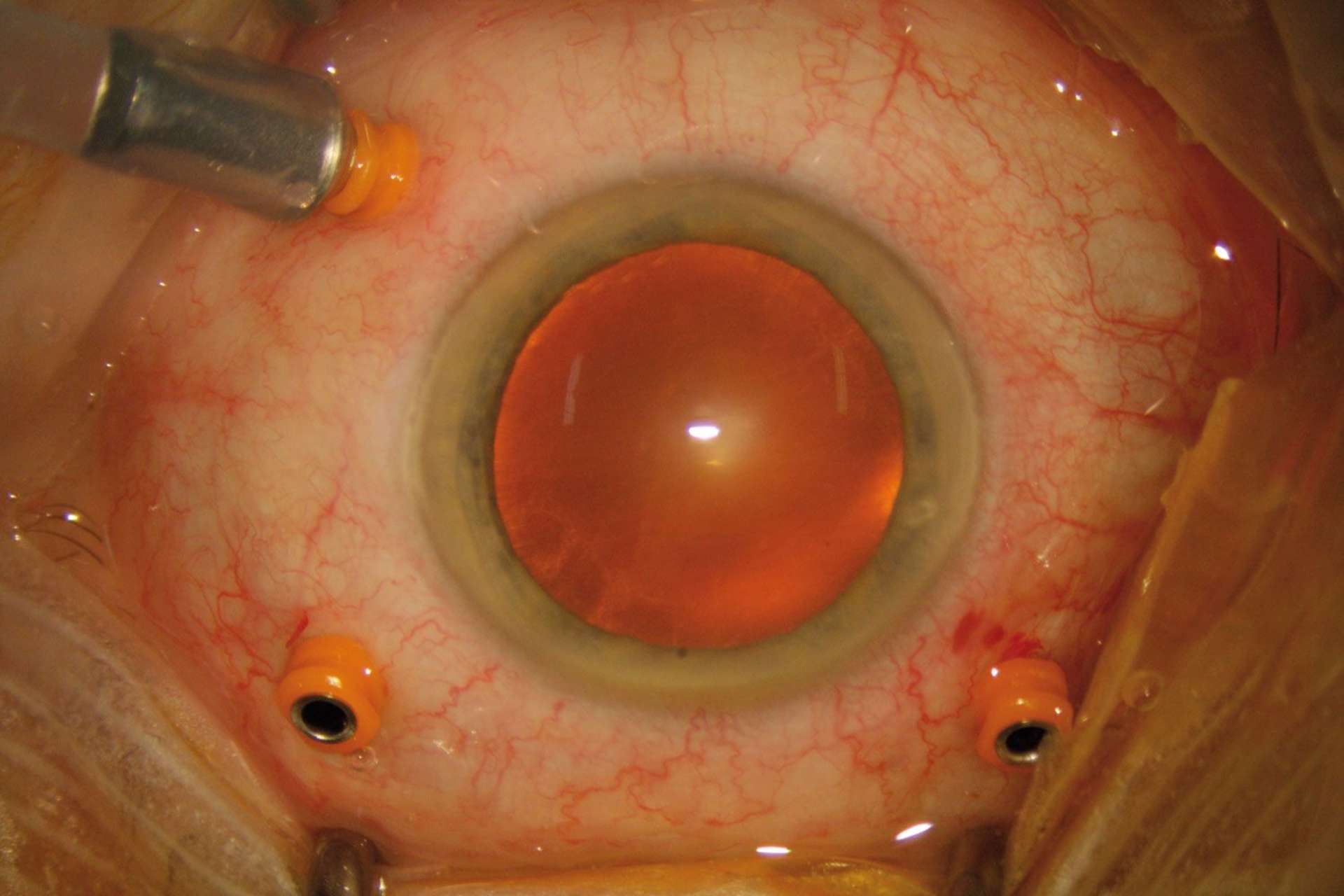 Chirurgie d’un trou maculaire sans suture ni désinsertion de la conjonctive
