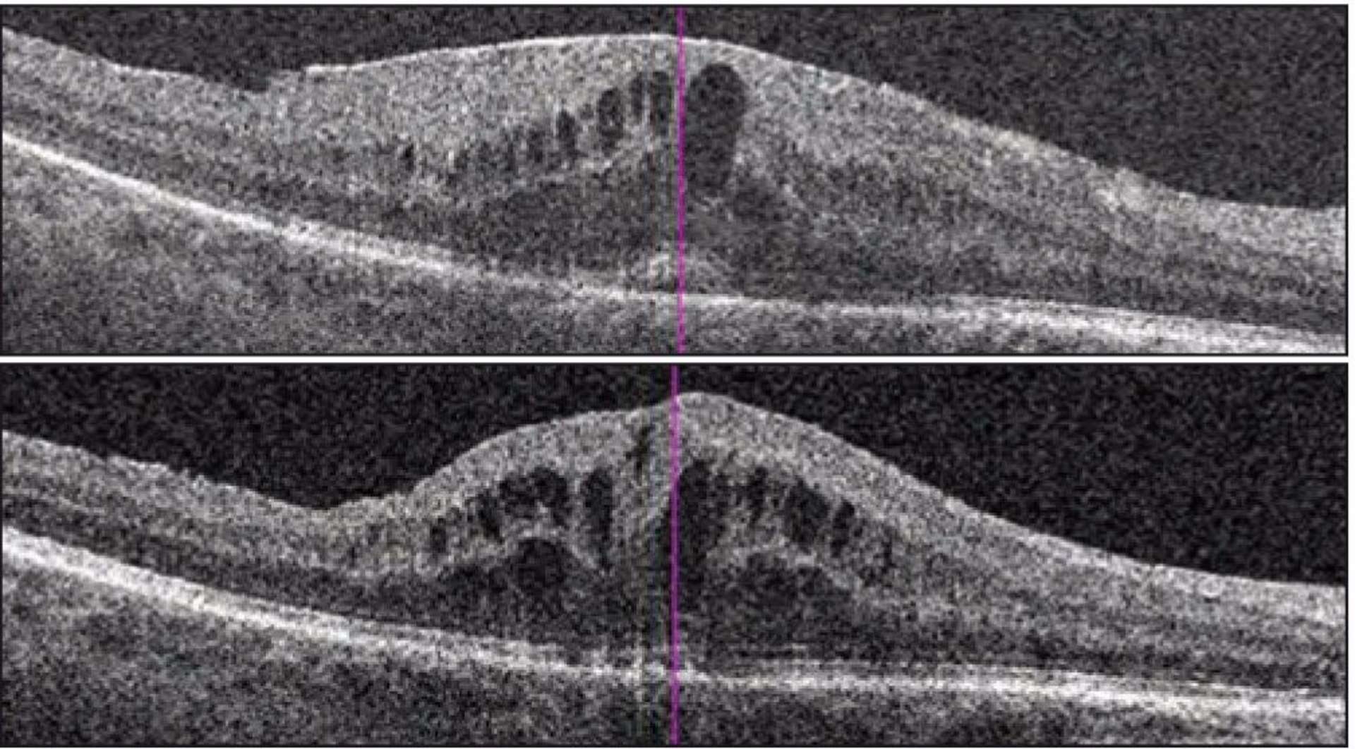 Coupe OCT montrant l’évolution après pelage de la membrane associé à un traitement par AINS topique et acétazolamide.
