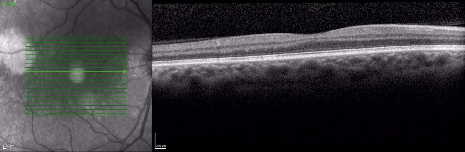 Figure 5. OCT à 4 mois du traitement.
