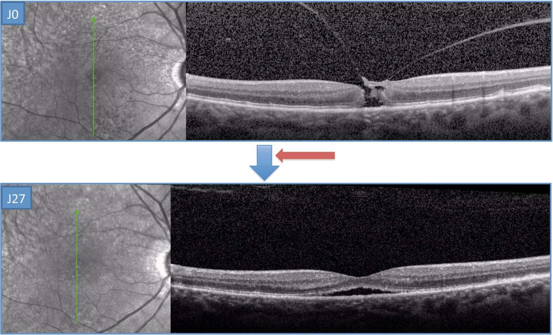 Syndrome de traction vitromaculaire associé à un trou maculaire (TM) de stade 2 chez un patient de 53 ans phaque. Une fermeture du TM est observée à J28 de l’IVT d’ocriplasmine avec un DSR persistant.
