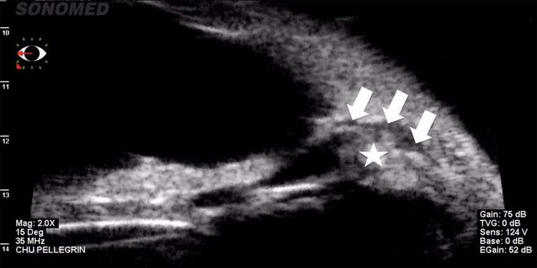 Figure 7. Incarcération ciliaire posttrabéculectomie en UBM (Sonde 35 MHz, VUmax, Sonomed, New York). Le corps ciliaire (étoile) est apposé contre l’orifice de trabéculectomie (trajet de l’humeur aqueuse au niveau des pointes de flèches). Absence de bulle de filtration.
