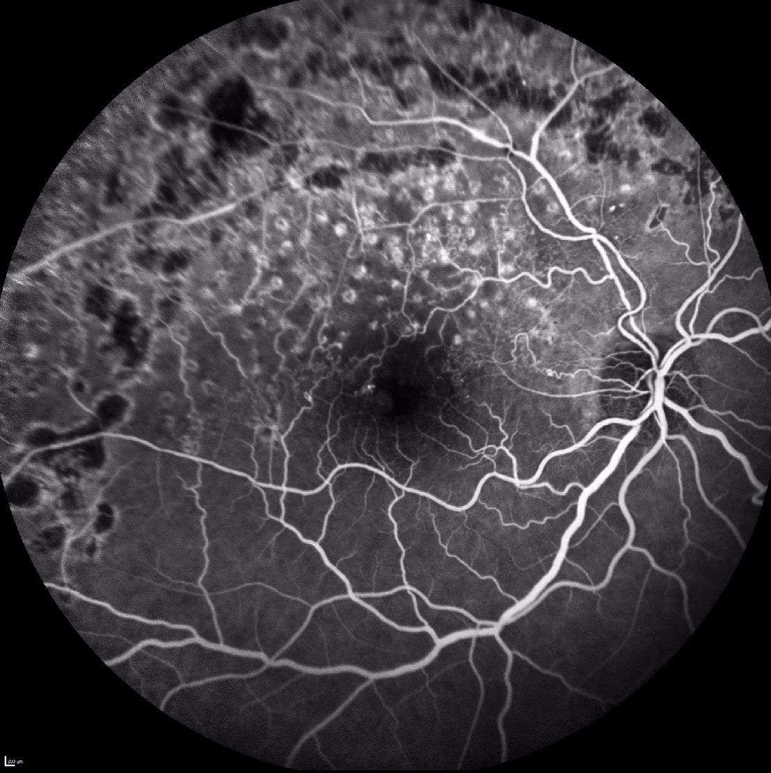 Figure 5. Cliché d’angiographie à la fluorescéine aux temps intermédiaires réalisé en postopératoire de la vitrectomie. Régression de la néovascularisation prérétinienne.
