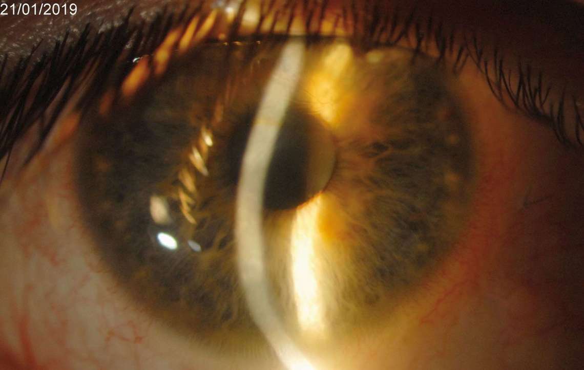 Figure 3. Photographie lampe à fente de l’œil droit à 1 an postopératoire. Un an après l’opération, l’hyperhémie conjonctivale et la taie cornéenne ont régressé. L’épithélium cornéen est stable et sans prise de fluorescéine. La meilleure acuité visuelle est de 2/10. La sensibilité cornéenne est retrouvée. Vidéo
