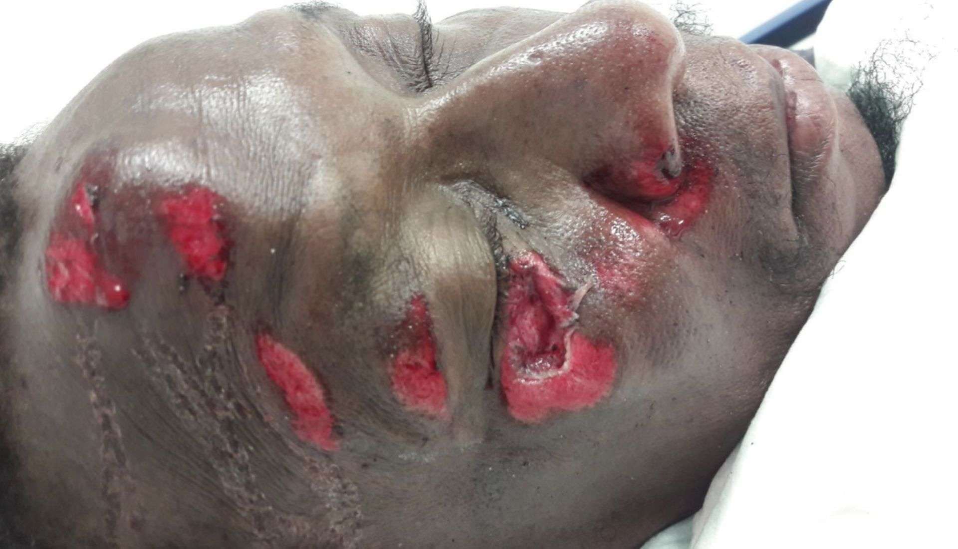 Figure 1. Dermabrasion intéressant la paupière inférieure droite dans un contexte d’accident de la voie publique. Remerciements au Pr Harold Merle.
