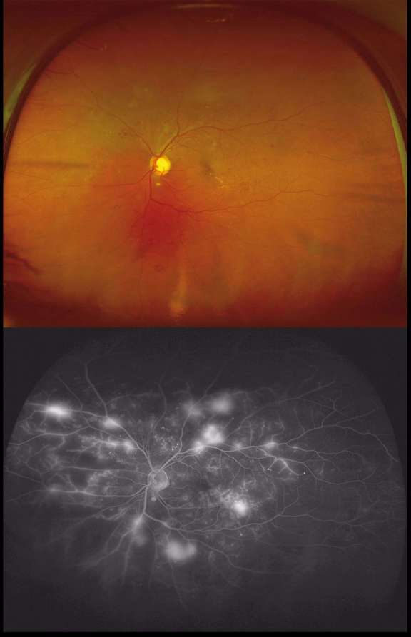 Clichés couleur et angiographique du fond d’œil à 200° réalisés avec une caméra Optos chez un patient diabétique présentant une rétinopathie diabétique proliférante.
