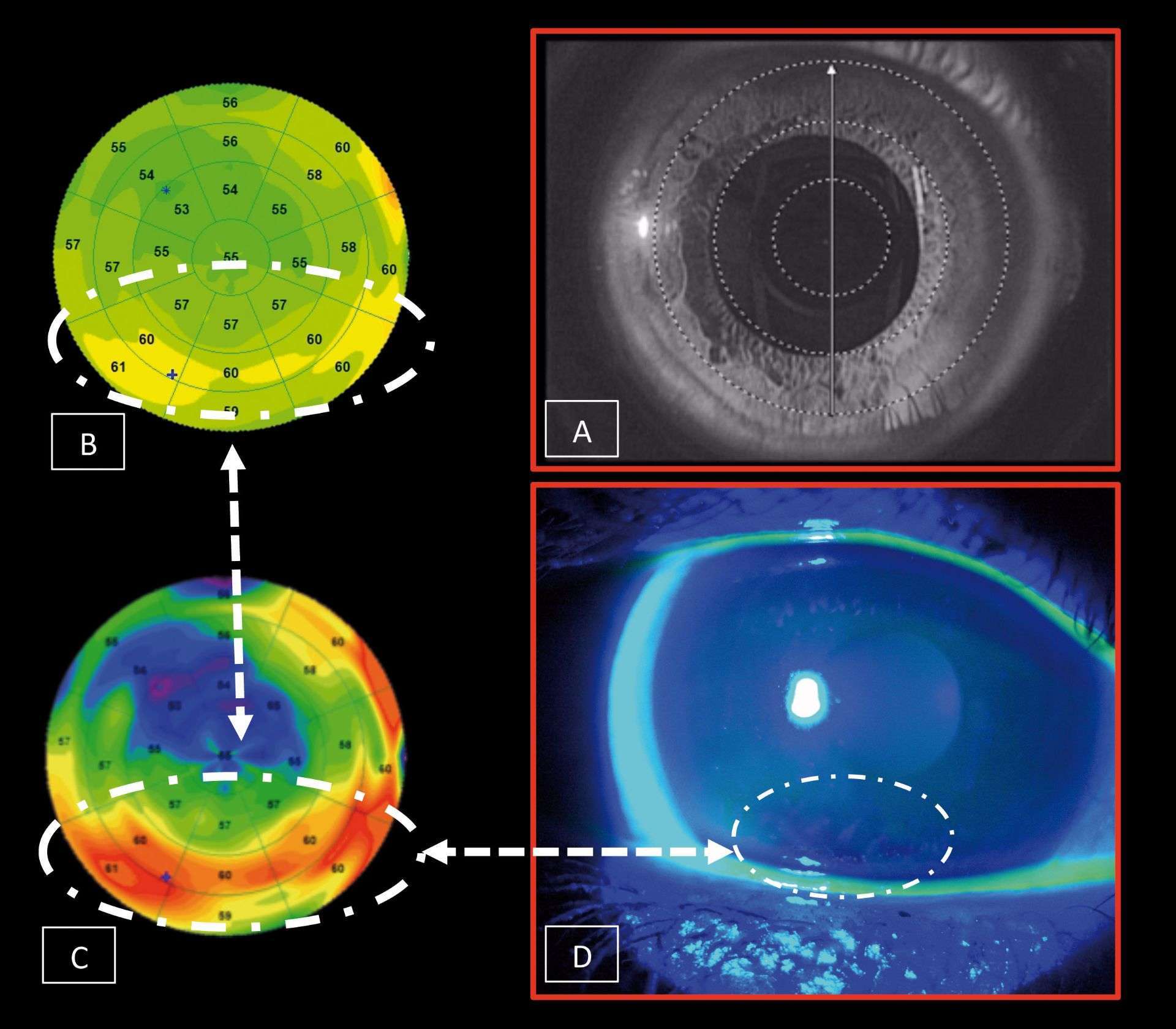 Figure 2. A. Image de la cornée du patient avec une caméra infrarouge de l’OCT lors de l’acquisition des images.

B. Topographie pachymétrique épithéliale soulignant une hyperplasie en forme de croissant en inférieur de l’apex.

C. Topographie pachymétrique épithéliale avec échelle normalisée soulignant de manière plus évidente cette hyperplasie.

D. Corrélation de l’examen du BUT montrant une rupture du film lacrymal associée à quelques ponctuations de kératite ponctuée superficielle correspondant exactement à la zone d’hyperplasie de l’épithélium cornéen.    
