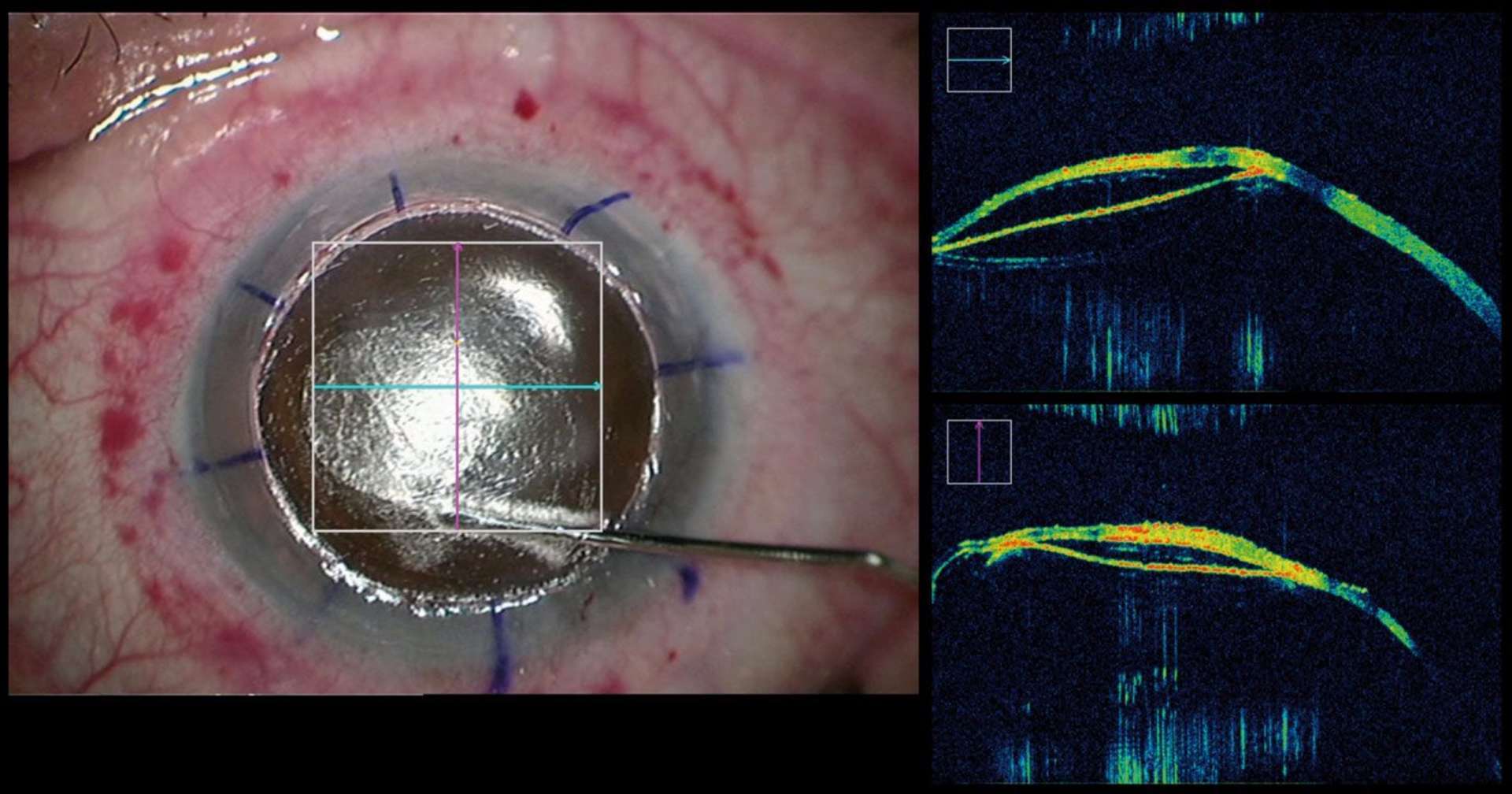 Figure 7. L’injection d’air a créé une bulle de type 1 (clivage entre le stroma et la couche de Dua et une bulle de type 2 (clivage entre la couche de Dua et la membrane de Descemet). La couche de Dua est bien visualisée, très hyperréflective, en arrière du stroma postérieur. La membrane de Descemet est plus postérieure et moins réflective (scan horizontal, ligne verte).
