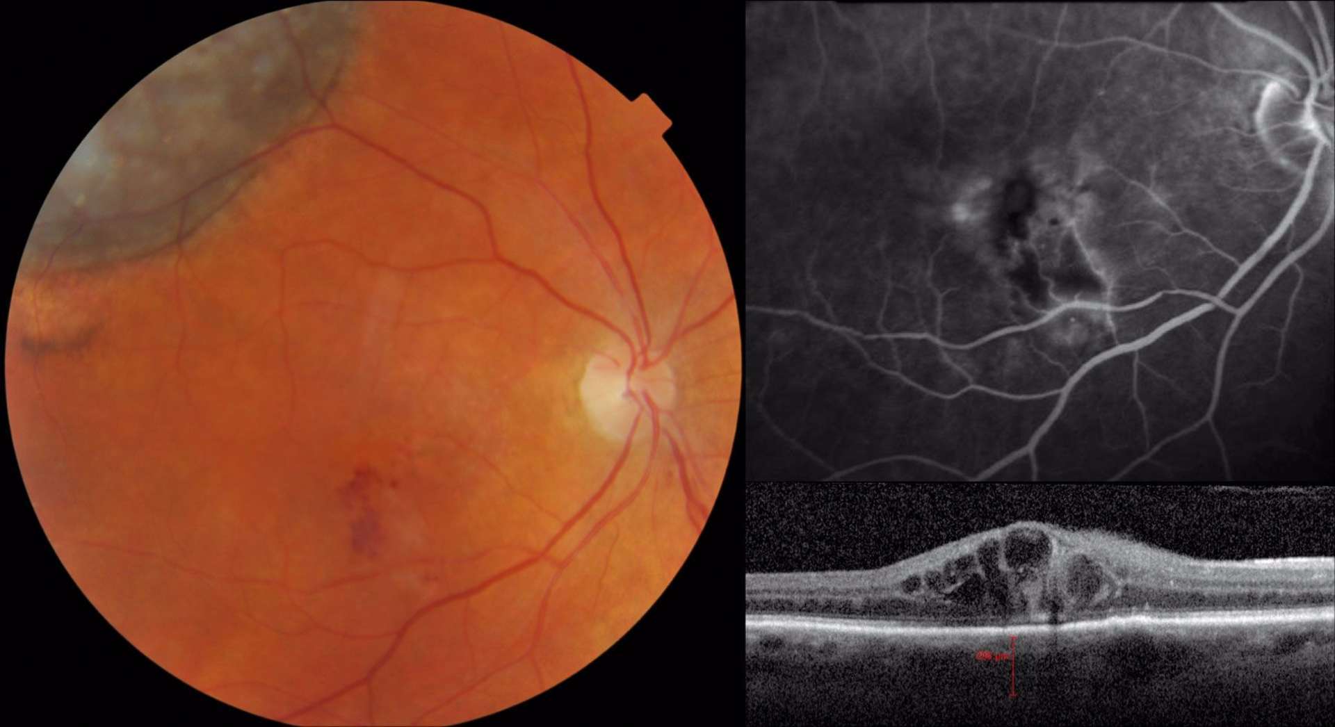 Patient présentant une maculopathie radique compliquant un mélanome choroïdien temporal supérieur de l’œil droit traité par protonthérapie. La rétinographie couleur montre des hémorragies rétiniennes en temporal inférieur de la macula. L’angiographie met en évidence une occlusion veinulaire ischémique. L’OCT confirme la présence d’un œdème maculaire
