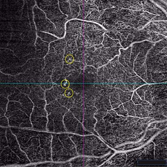 Figure 2. Microanévrysmes visibles en OCT-A au niveau du plexus capillaire profond de l’œil droit chez une femme de 92 ans suivie pour une rétinopathie diabétique non proliférante modérée.
