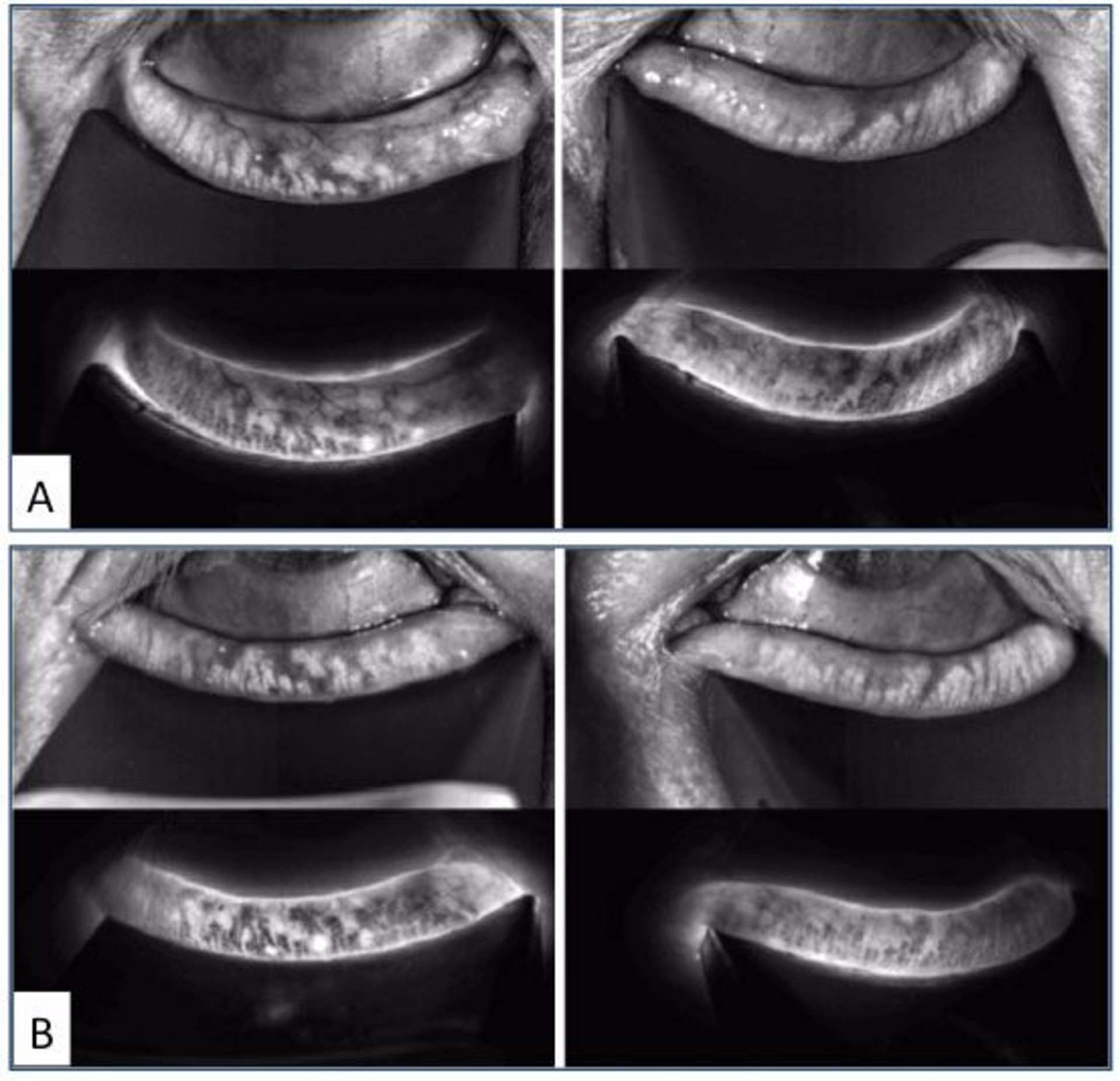 Figure 4. Nette diminution des télangiectasies en Lipiview II, après une seule séance d’IPL Lacrystim. A. Meibographie pré-IPL ; B. J7 post-IPL.
