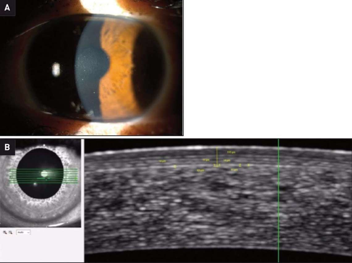 Figure 6. A. À 1 mois postopératoire, la cornée est claire. B. En OCT, seul le capot cornéen est observable, le lenticule n’est pas visualisé.

