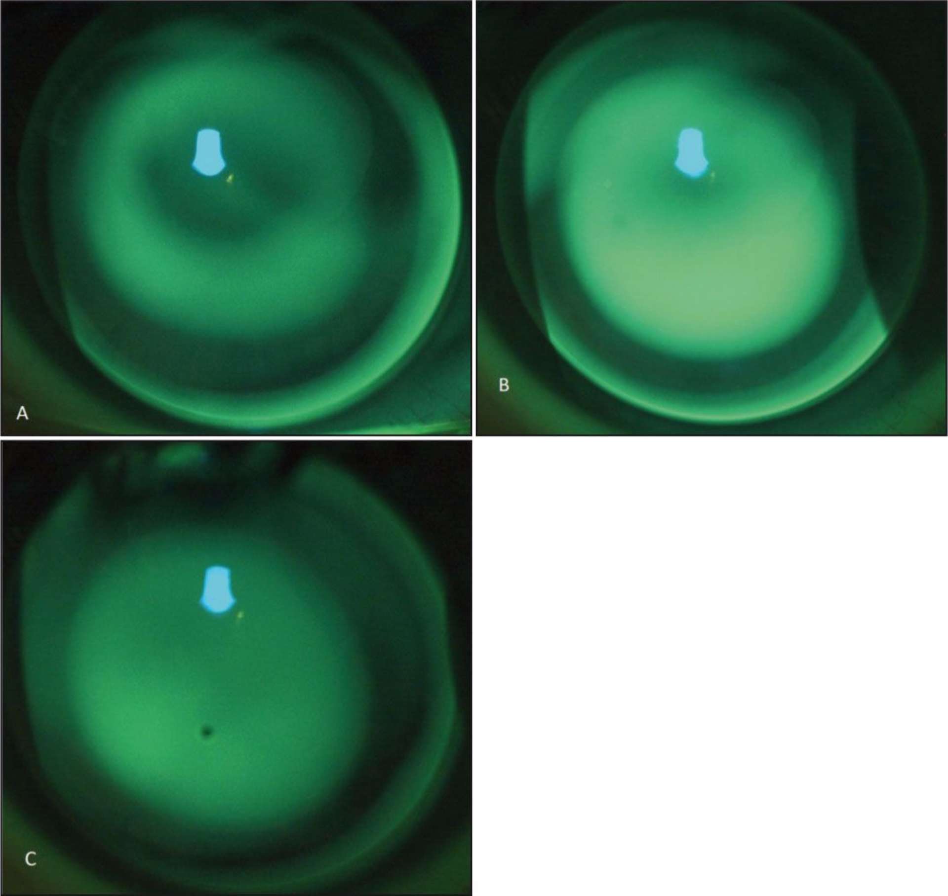 Figure 3. A. Apex (zone sombre) trop visible témoignant d’un rayon de courbure trop plat. B. Rayon plus serré de 0,10 mm, apex (zone sombre) légèrement visible. C. Rayon plus serré de 0,10 mm, apex non visible. La première clairance apicale est l’image C. Le rayon de courbure à garder est celui de l’image B.
