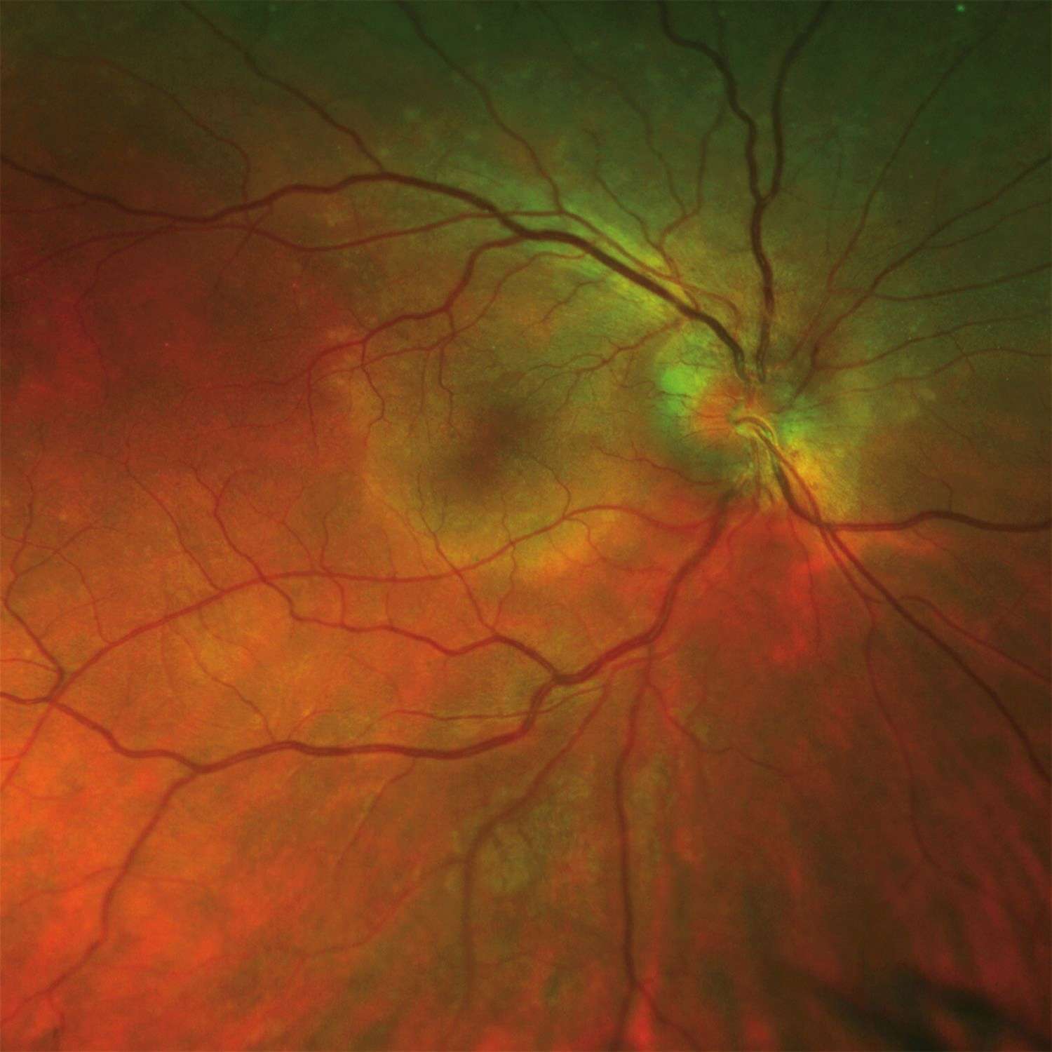 Figure 1. En imagerie autofluorescence de la rétine, visualisation d’une vaste lésion hyper-autofluorescente (ou blanche) au pôle postérieur de la rétine.
