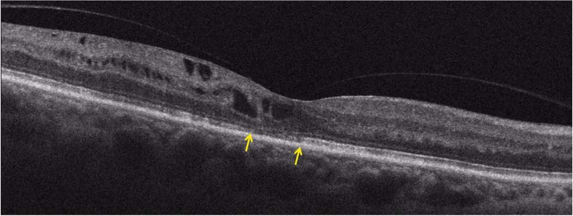 Figure 1. C. Coupe B-scan après 1 an de traitement anti-VEGF ; l’interruption de la ligne ellipsoïde (flèches jaunes) va altérer le résultat fonctionnel.
