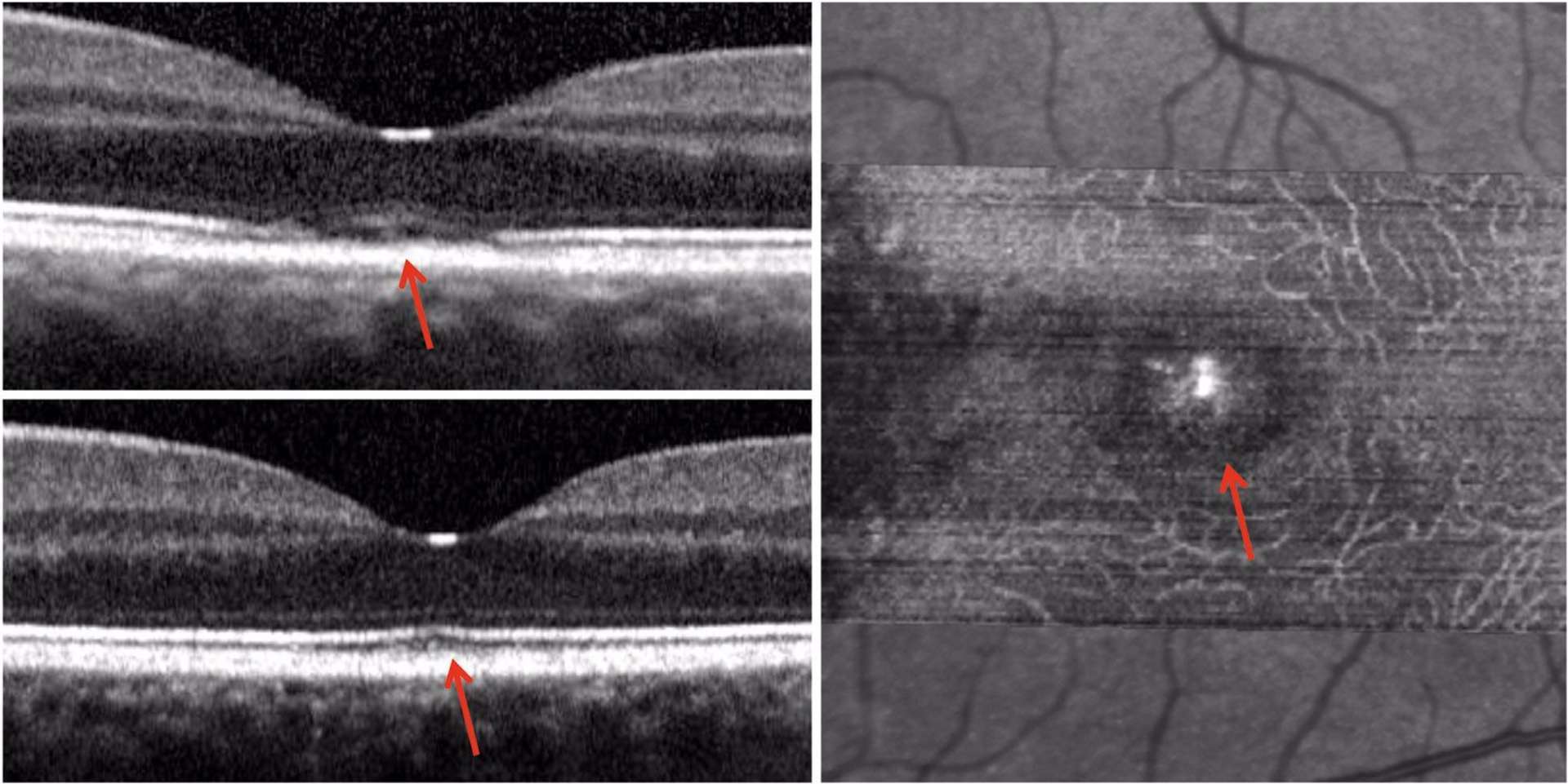 ARPE (Acute Retinal Pigment Epitheliitis). Disruption de la ligne IS/OS à la phase aiguë (a) avec autorésolution anatomique et fonctionnelle à 21 jours (b). L’OCT en face retouve cette lésion sous la forme d’une hyperréflectivité rétrofovéolaire, circulaire, de la rétine externe (c).
