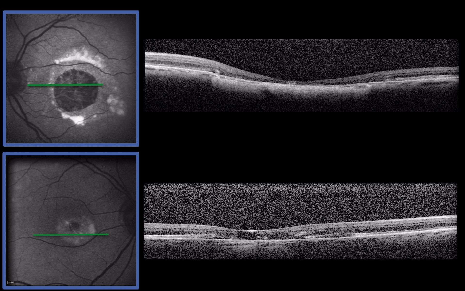 Figure 3. Imagerie multimodale d’un cas de dystrophie pseudovitelliforme chez une patiente âgée de 76 ans. Dans son stade atrophique (première ligne), la dystrophie pseudovitelliforme montre une page d’atrophie ronde, symétrique, entourée par un bord hyperréflectif en autofluorescence (carré bleu). Cette plage d’atrophie ne s’étend pas au fil du temps. L’œil controlatéral montre une étape plus précoce, caractérisé par une hyperfluorescence propre à la dystrophie pseudovitelliforme.
