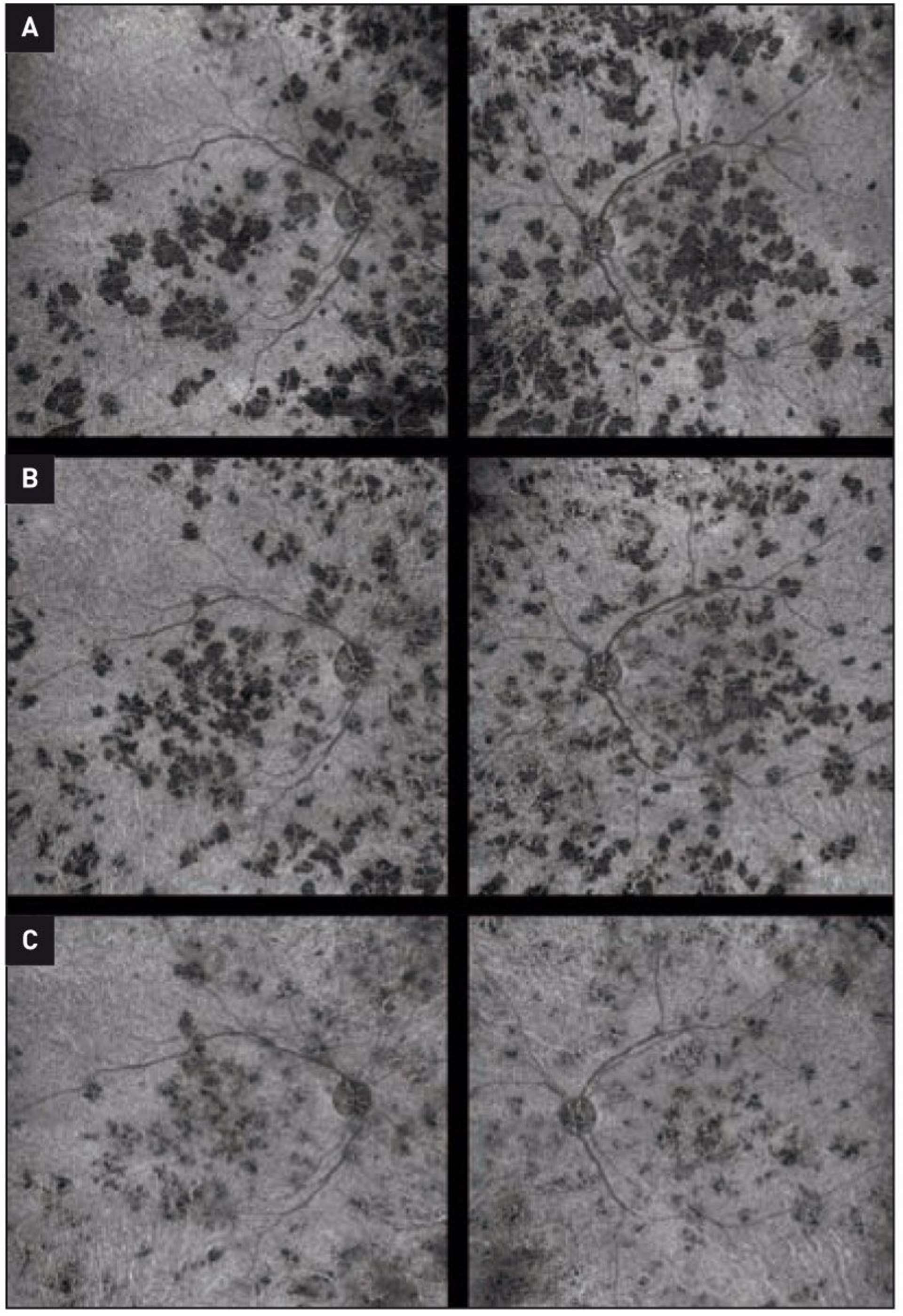 Figure 4. Évolution des zones de diminution du flux choriocapillaire à l’OCT-A. A. À 1 semaine. B. À 2 semaines. C. À 3 semaines.
