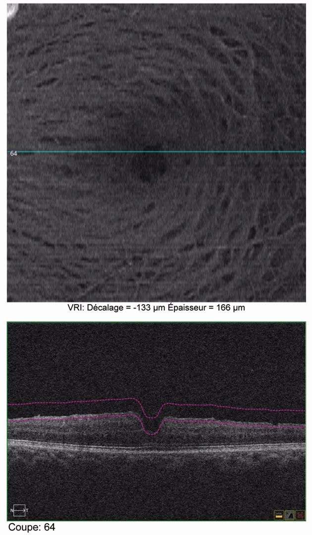 Figure 2. OCT en face au niveau de la VRI (vitreorétinal interface) permettant de visualiser les stries courbes plus sombres que la rétine adjacente.
