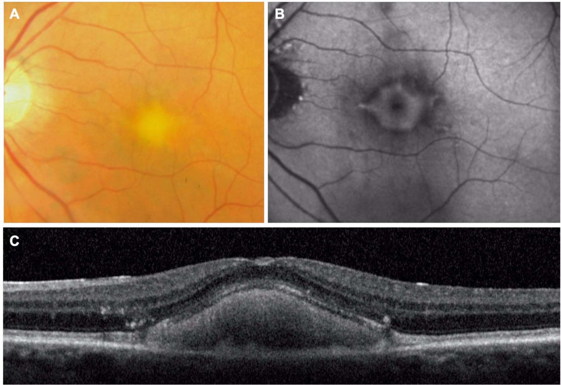 Figure 2.Les clichés couleur (A) et en autofluorescence (B) montrent un dépôt fovéolaire jaunâtre, arrondi, hyper-autofluorescent. En OCT-SD (C ), le dépôt réalise un dôme hyperréflectif sous-rétinien, homogène, associé à des migrations pigmentaires dans les couches rétiniennes externes. L’architecture de la rétine neurosensorielle en regard est respectée.
