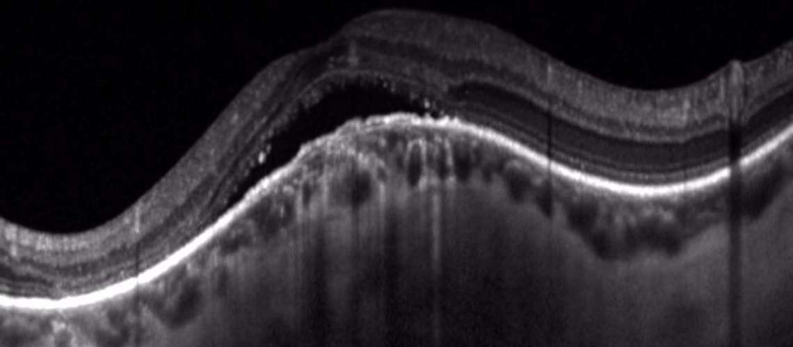 Figure 4. Coupe OCT horizontale d’une macula bombée chez une patiente présentant une myopie modérée.
