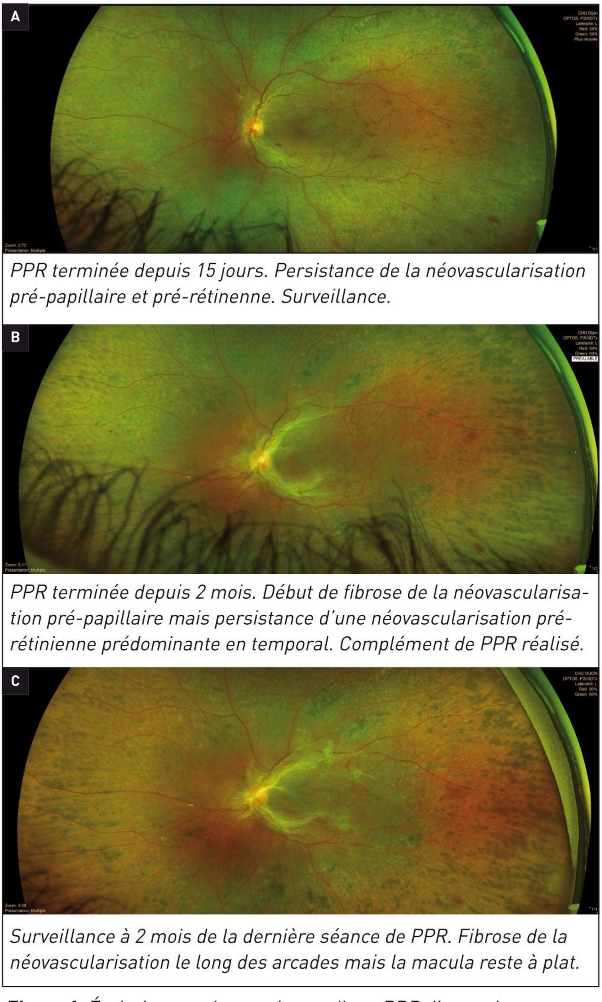 Figure 1. Evolution et prise en charge d’une RDP d’un patient ayant bénéficié d’une PPR.
