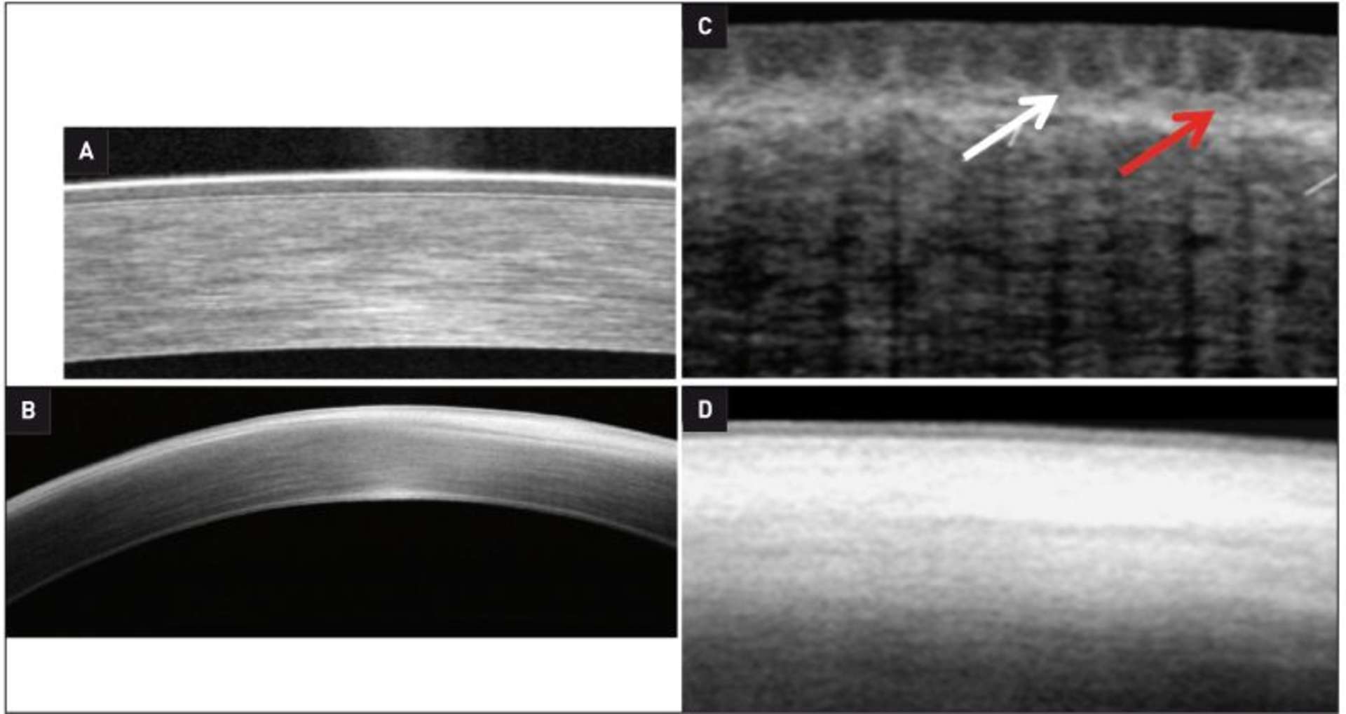 Figure 5. Tomographie en cohérence optique d’une cornée normale et d’une cornée avec un déficit en cellules souches limbiques.
A : coupe cornéenne centrale normale ; B : coupe cornéenne ­centrale avec une fibrose sous-épithéliale (DCSL) ; C : coupe parallèle au limbe normal. Visualisation de nettes ondulations régulières ; D : coupe parallèle dans un DCSL. Stroma plat et hyperréflectif, recouvert par un épithélium fin.
