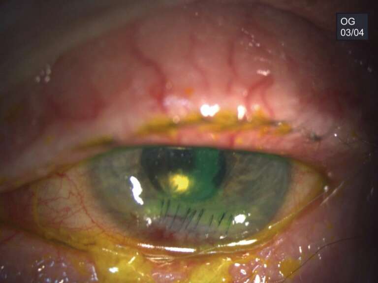 Figure 2. Reprise postopératoire des sutures cornéennes de l’œil gauche.
