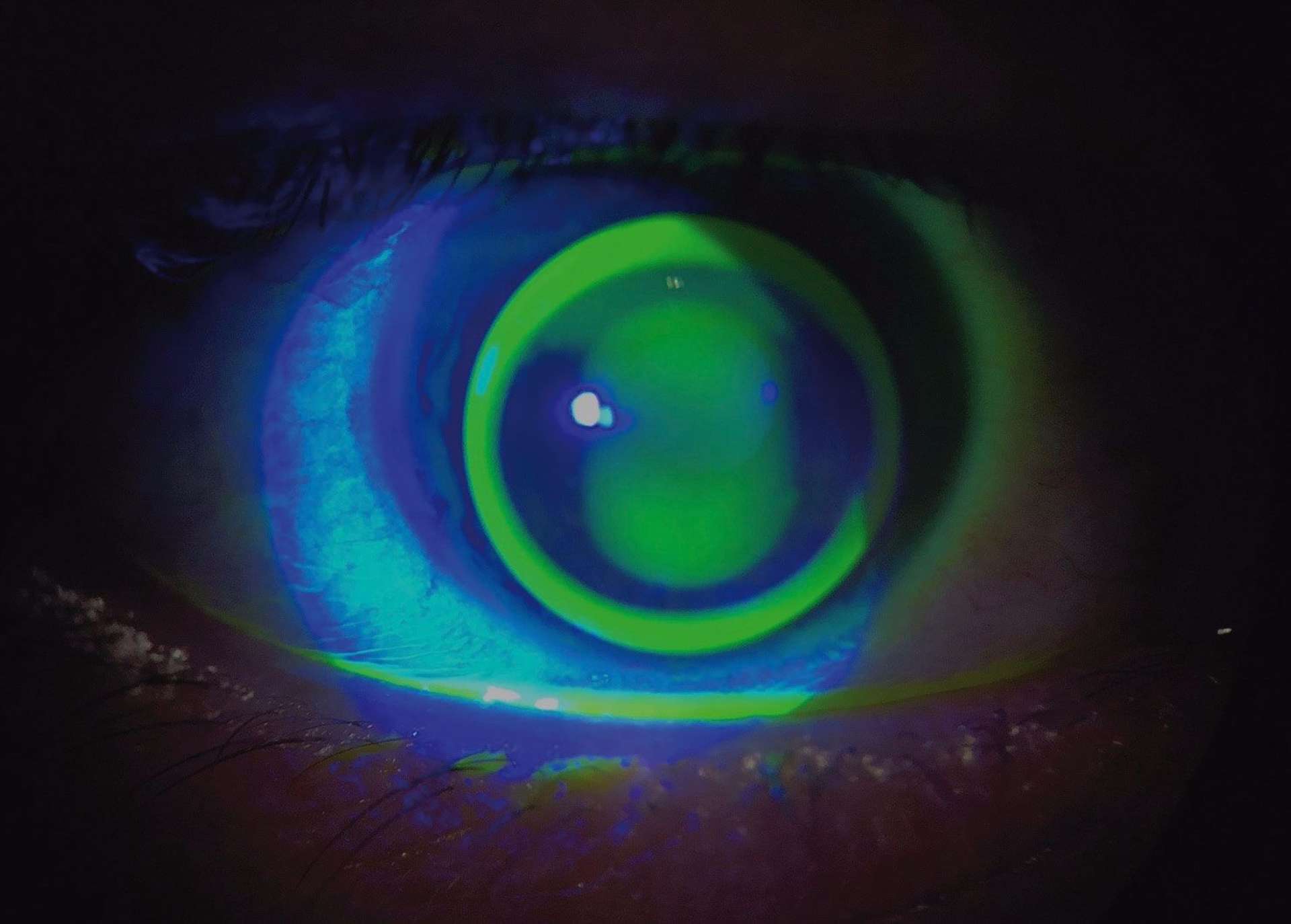 Figure 3. Image fluo œil gauche.
