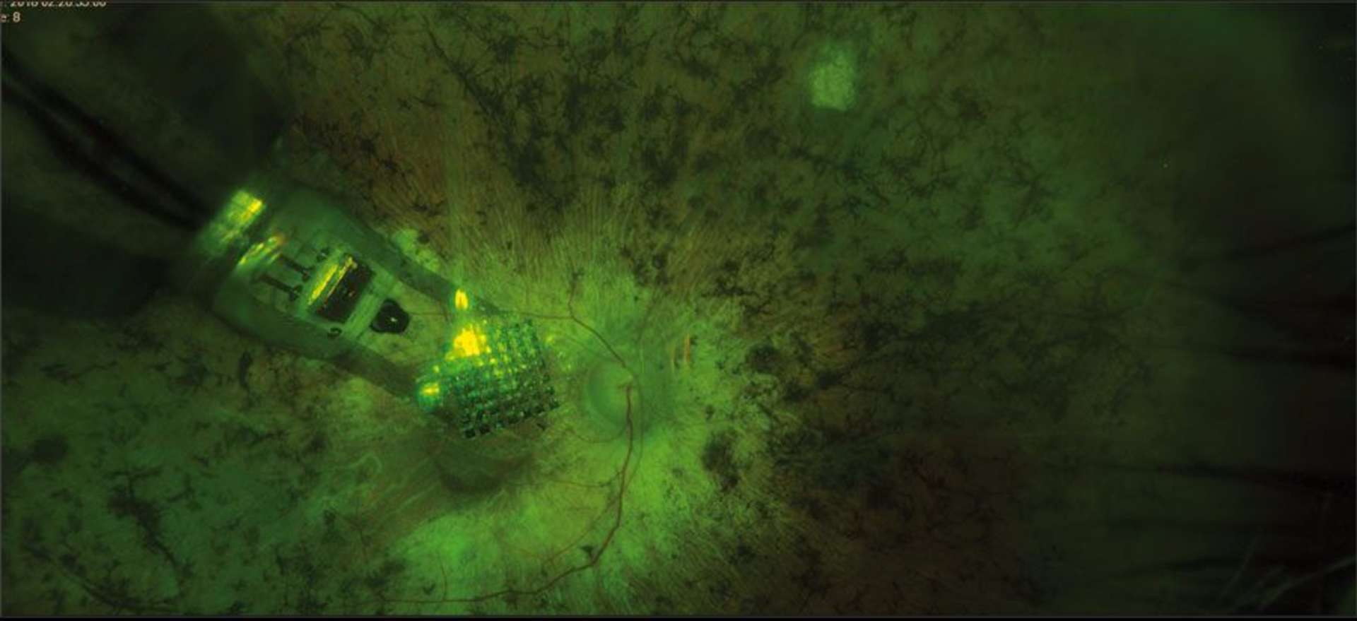 Figure 1. Implant prérétinien IRIS II fixé sur la macula chez un patient porteur d’une rétinopathie pigmentaire terminale.
