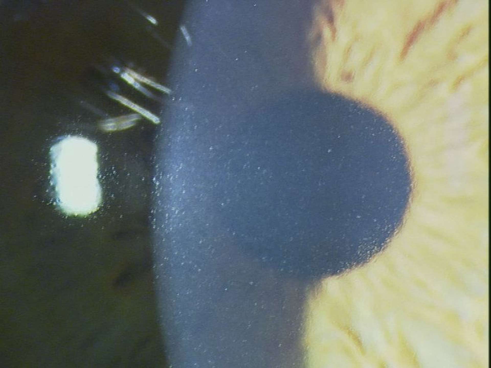 Figure 1. DLK de stade 2. On y voit ces petits infiltrats sableux répartis de manière diffuse, atteignant l’axe visuel, sans fibrose stromale. Ils ont régressé après un renforcement de la corticothérapie topique.
