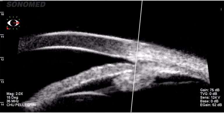 Figure 1. Iris plateau en UBM (sonde 35 MHz, VUmax, Sonomed, New York). Le corps ciliaire est en avant d’une ligne perpendiculaire à la surface épisclérale passant par l’éperon scléral (antéposition et antérotation du corps ciliaire). Absence de sulcus ciliaire et chambre antérieure de profondeur normale.
