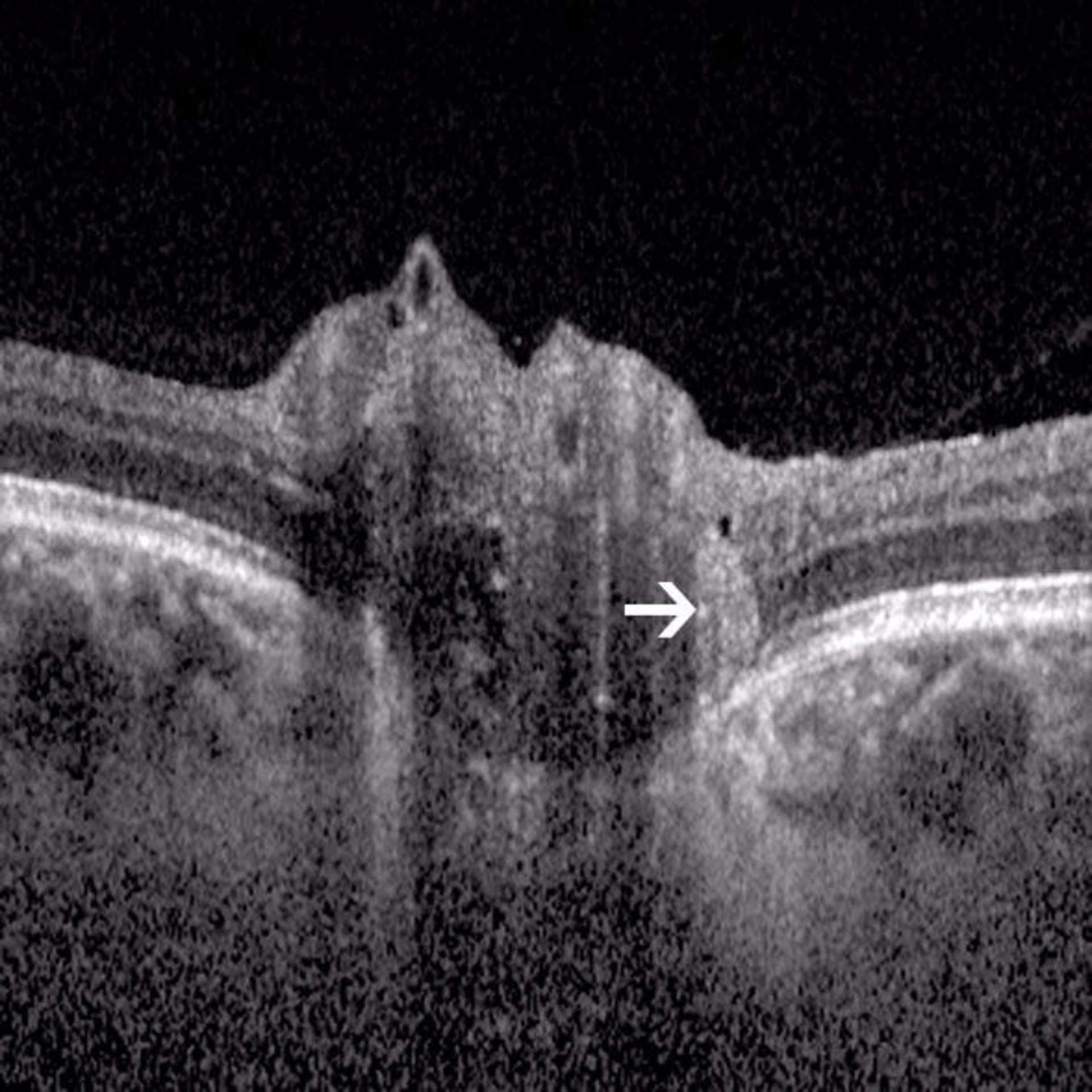 Figure 7.  PHOMS, lésions arrondies hyperréflectives localisées aux bords papillaires.
