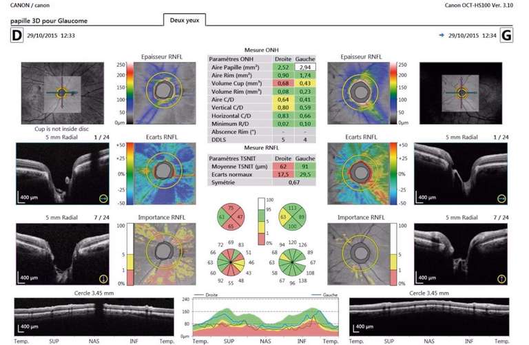 Figure 1. &nbsp;OCT fibres objectivant un amincissement des fibres optiques de la région temporale de l’œil droit. À noter : l’aspect asymétrique.&nbsp;
