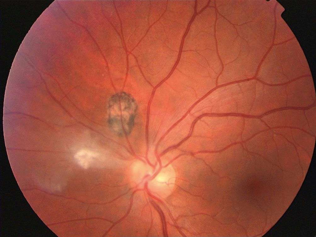 Figure 1. Photographie du fond d’œil. Foyer de rétinochoroïdite actif jouxtant une cicatrice secondaire à une toxoplasmose. 
