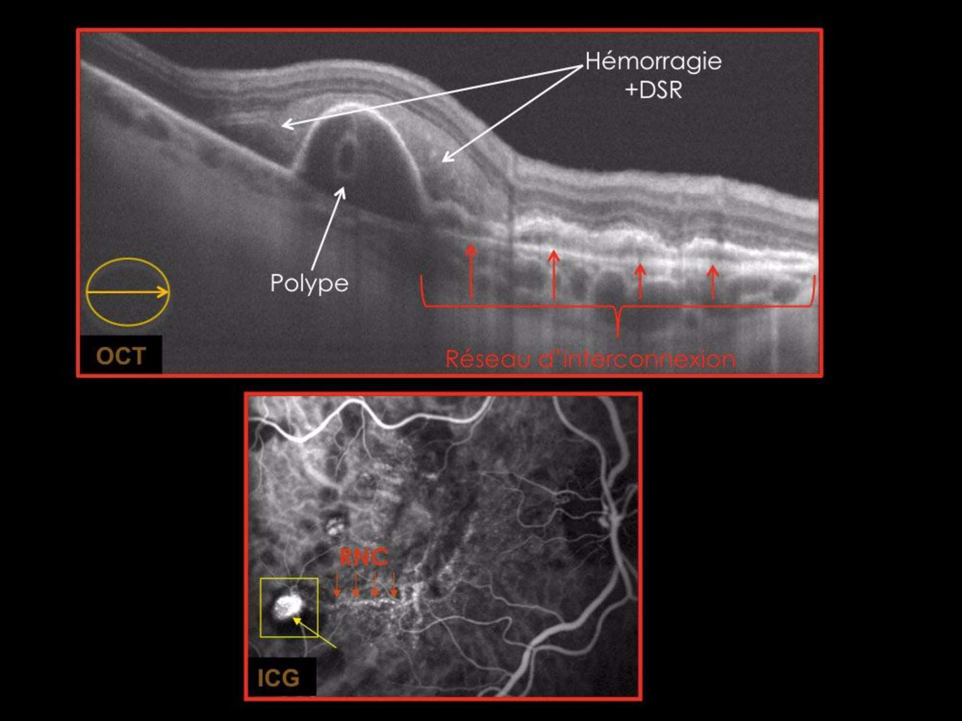 L’ICG visualise la trame d’interconnexion et les polypes à son extrémité temporale. L’OCT B-scan montre une élévation ondulée de l’épithélium pigmentaire (EP) (double-layer sign) s’ouvrant sur un décollement séreux de l’EP. Au sein du décollement de l’épithélium pigmentaire, on observe une structure ronde et optiquement vide représentant la dilatation polypoïdale.
