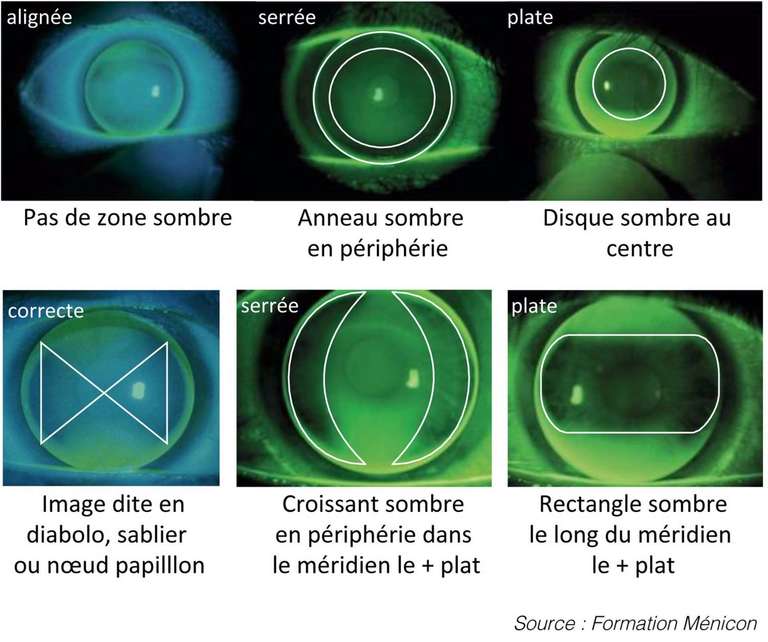 Principes d’adaptation d’une lentille cornéenne rigide perméable au gaz ...
