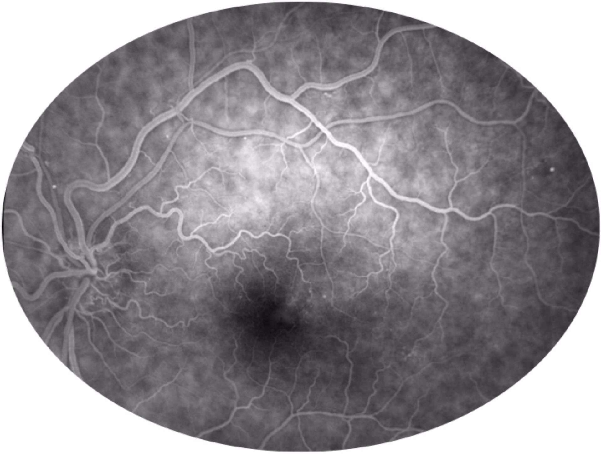 Figure 3. Cliché de l’angiographie à la fluorescéine OG à 59 secondes : important allongement du temps de remplissage artérioveineux.
