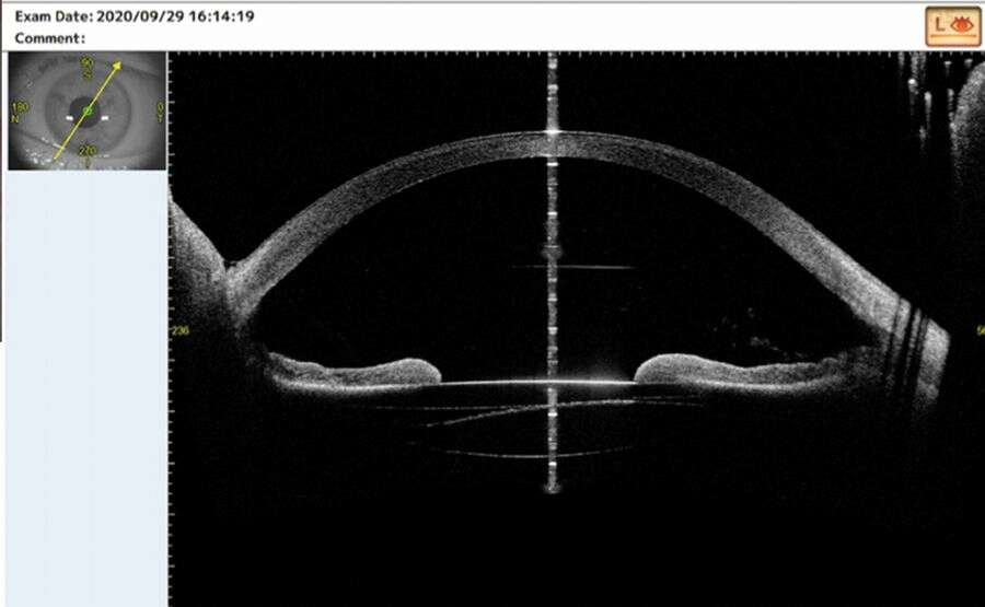 Figure 3. Imagerie OCT SS montrant le décentrement de l’implant de sulcus, la finesse de la cornée, l’imposante profondeur de la chambre antérieure (4,36 mm).
