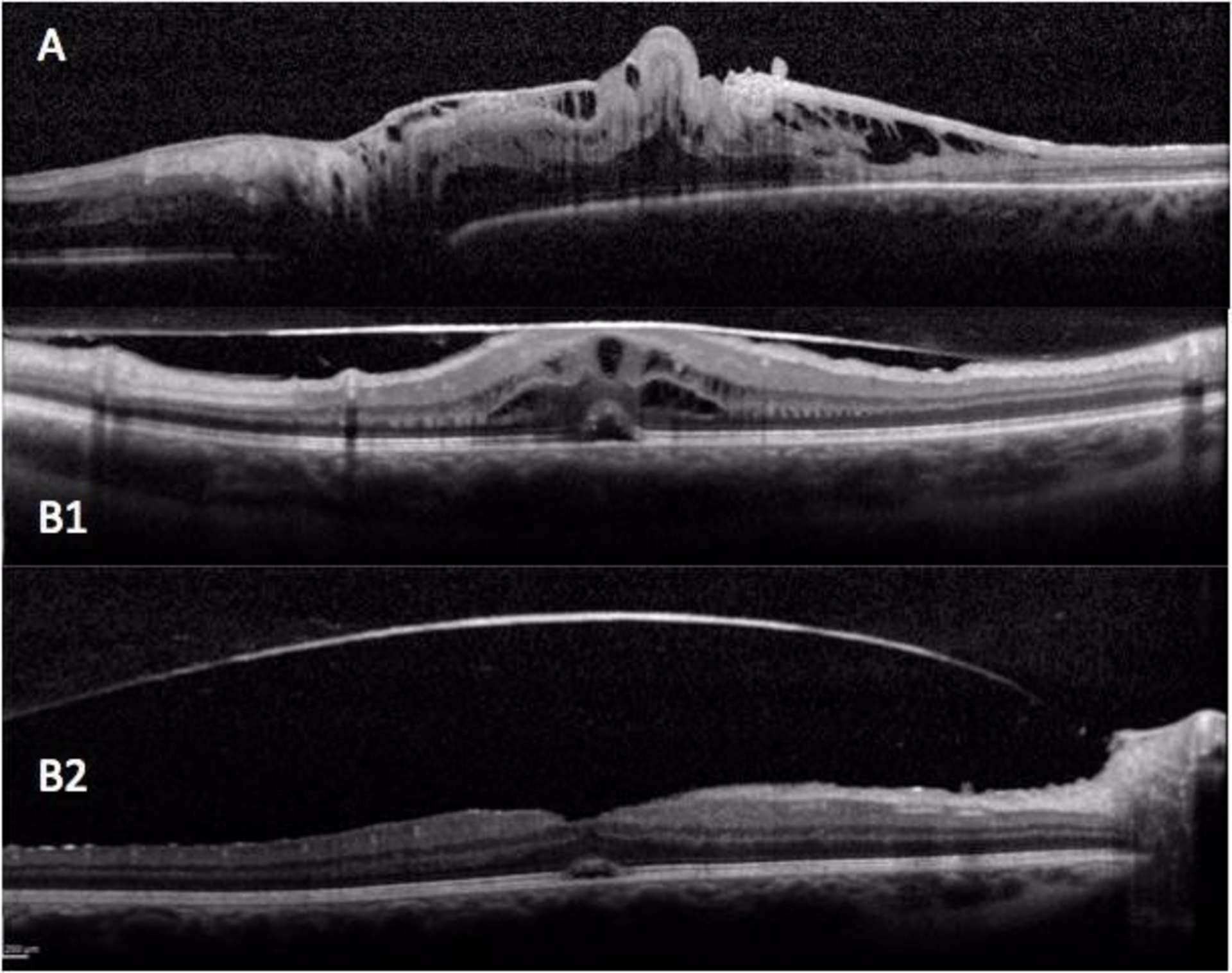 Anomalies inflammatoires de l’interface vitréomaculaire.
