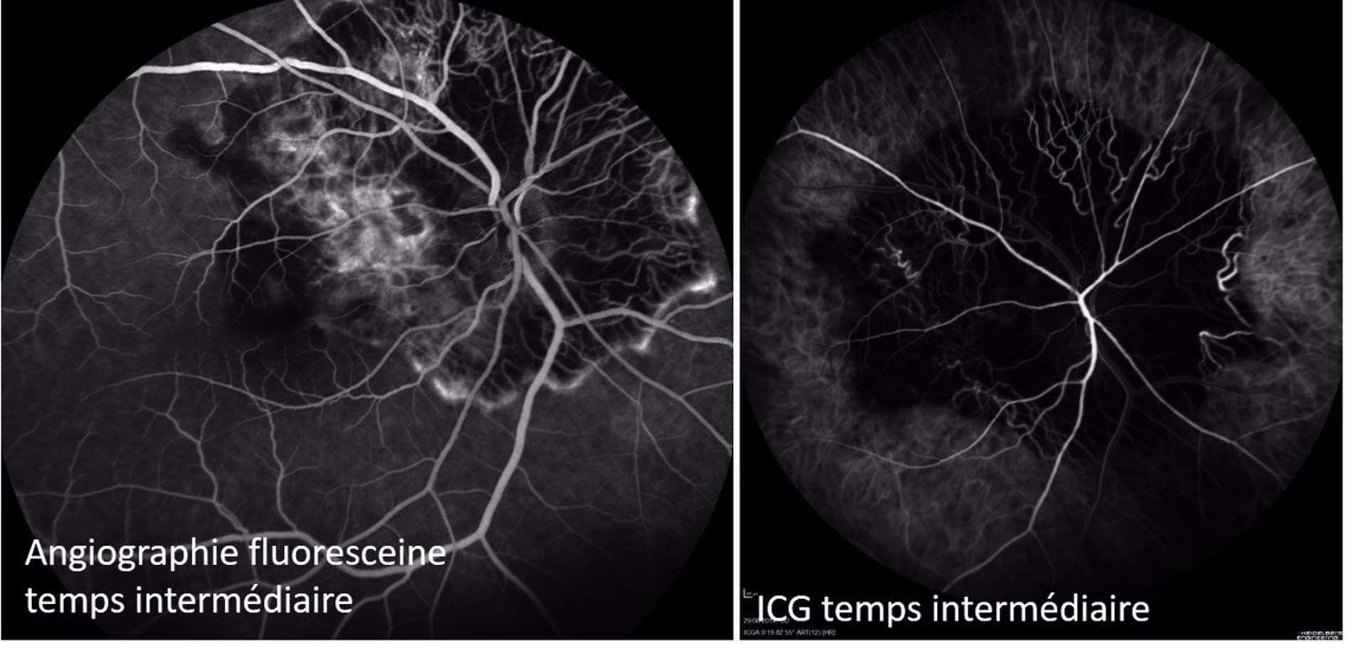 Figure 5. Choroïdite serpigineuse. En FA, le front actif de la lésion est hypofluorescent, et hyperfluorescent dans sa zone inactive. L’ICG montre une lésion hypofluorescente.
