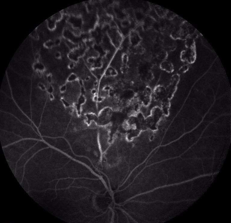 Figure 4. Angiographie à la fluorescéine de l’œil droit postopératoire d’une vitrectomie pour une occlusion de branche veineuse rétinienne supérieure.
