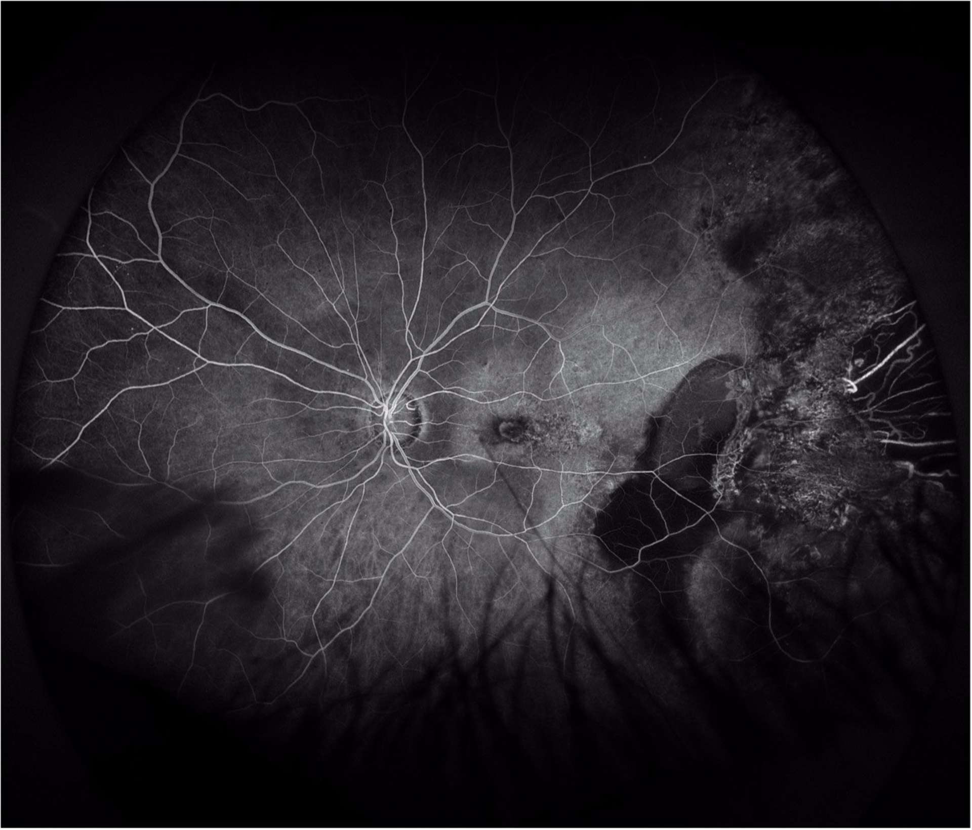 Figure 2. Cliché d’angiographie à la fluorescéine en ultra grand champ de l’œil gauche (30 sec). On note un effet masque avec un blocage de la diffusion choroïdienne au niveau des plages hémorragiques. On constate aussi un effet fenêtre avec visualisation d’une zone d’atrophie en périphérie temporale ainsi que des altérations de l’épithélium pigmentaire. On visualise également au niveau maculaire une diffusion bien circonscrite accompagnée en temporal de pin points.
