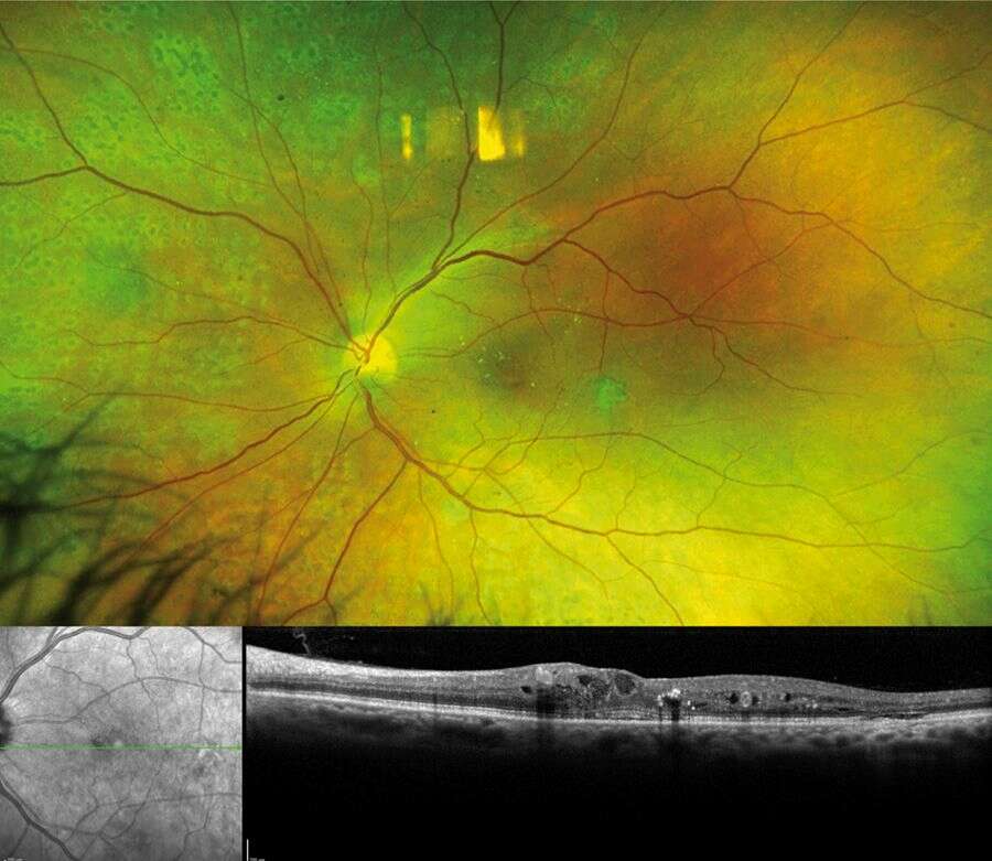 Figure 1. Rétinophotographie couleur ultra grand champ avec PPR partielle OG, OCT maculaire montrant un œdème maculaire central avec fluide intra- et sous-rétinien et des points hyperréflectifs.
