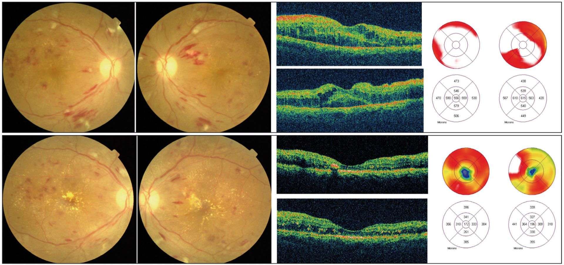 Figure 2. Patient diabétique de type 2 présentant une baisse visuelle bilatérale en relation avec un œdème maculaire bilatéral. Il est en insuffisance rénale terminale. En haut : les photos couleur montrent une rétinopathie diabétique aggravée par une rétinopathie hypertensive. L’OCT objective un œdème maculaire bilatéral associé à un décollement séreux rétinien. En bas : 1 mois après la mise sous dialyse, les signes de rétinopathie hypertensive ont diminué. Des exsudats de résorption sont apparus du fait de la résolution rapide de l’OMD. L’OCT montre une diminution drastique de l’OMD avec un retour à une épaisseur quasi normale.
