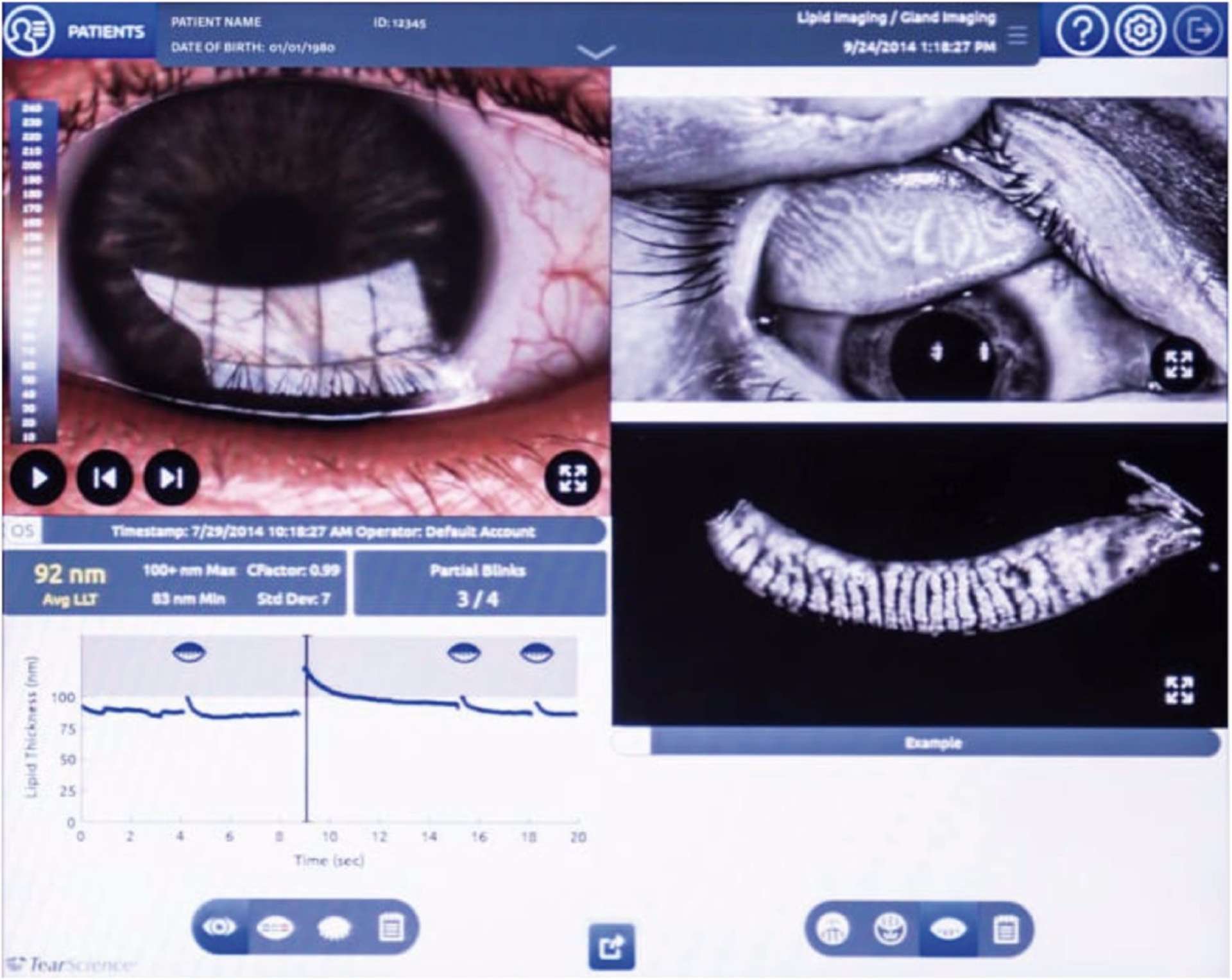 Figure 3. Capture d’écran d’un examen par Lipiview typique avec mesure de l’épaisseur du film lipidique et meibographie.
