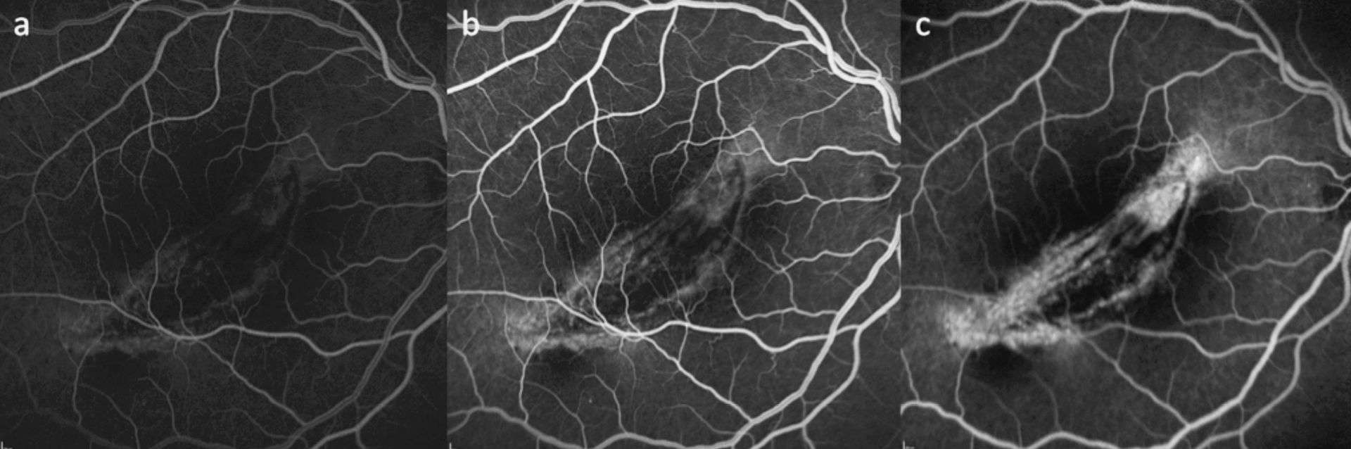 Figure 2. Angiographie à la fluorescéine. A. Au temps précoce. B. Au temps intermédiaire. C. Au temps tardif, montrant une prise de contraste sans réelle diffusion, dénotant d’un probable effet fenêtre. À noter que la zone nasale supérieure, qui semble diffuser, ne correspond à aucune lésion sur le cliché OCT correspondant.
