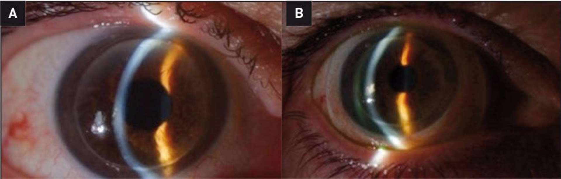 Figure 6. Exemple d’adaptation en lentille sclérale. A. Glissement du greffon bien visible en lampe à fente. B. Lentille sclérale  présentant un réservoir de profondeur correcte et pas de blanchissement au niveau des appuis scléraux.
